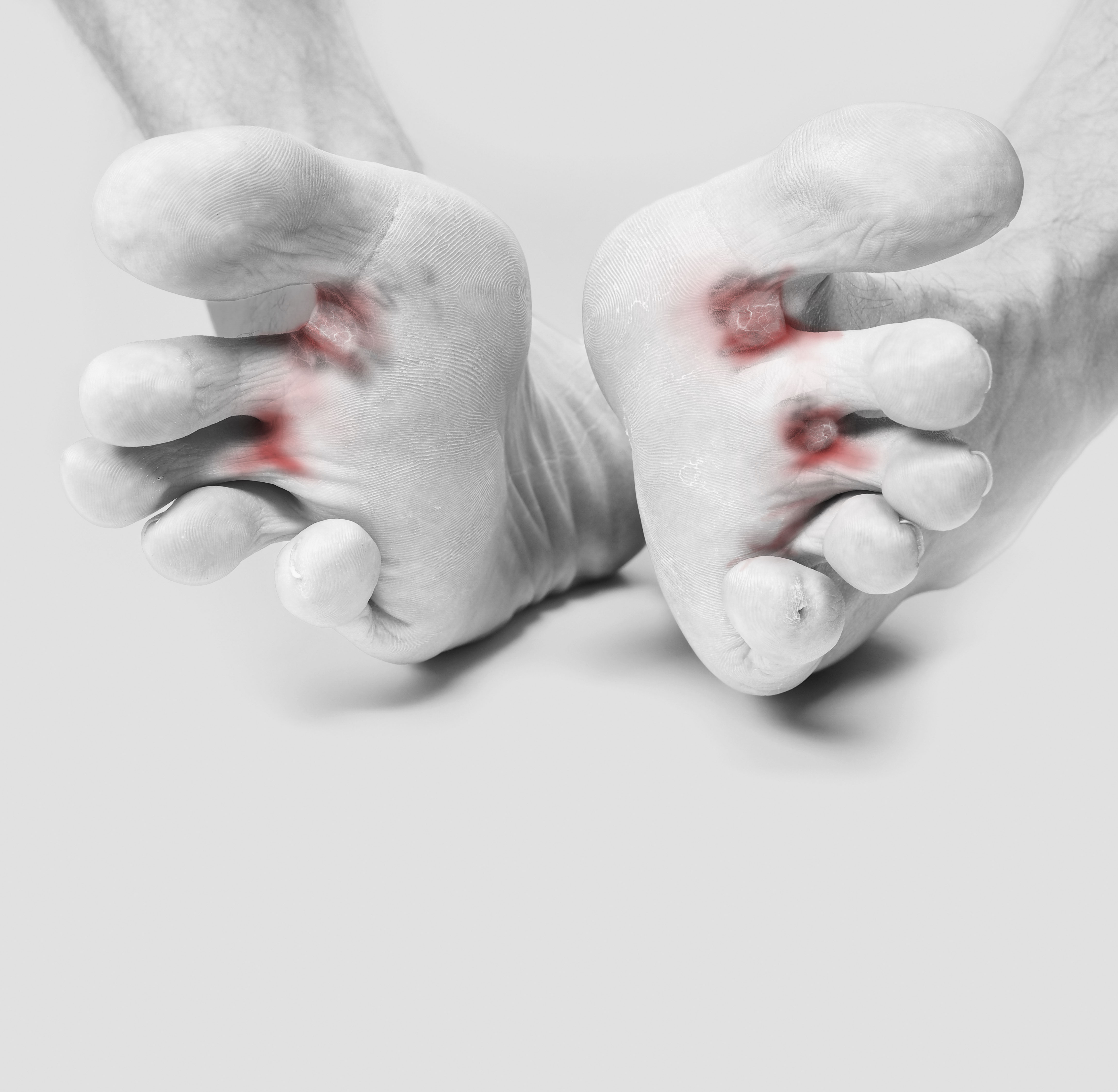 Closeup of foot with Athlete's Foot Closeup of foot with Athlete's Foot