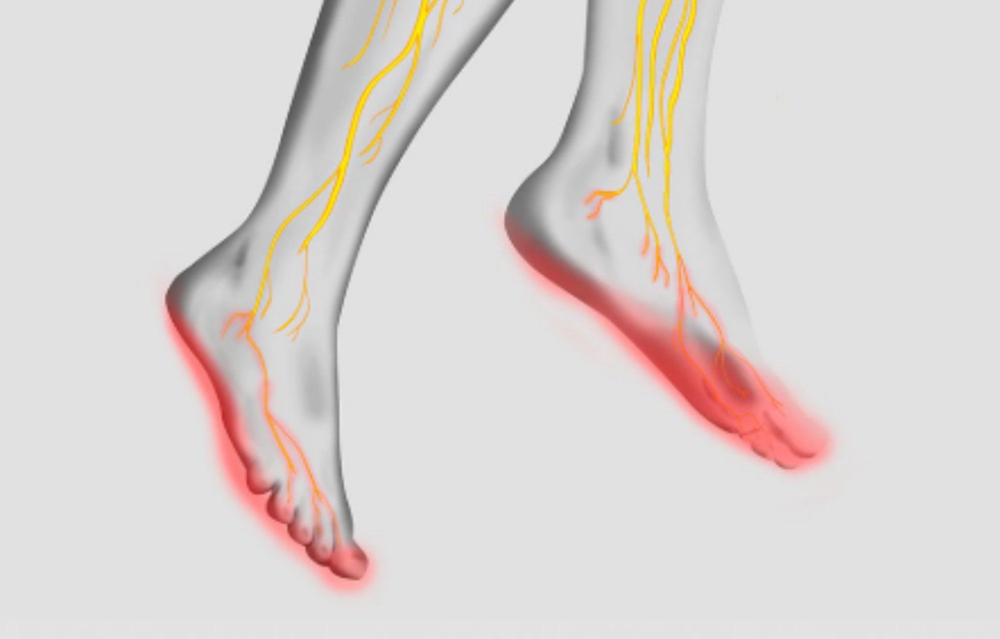 Closeup of how diabetic neuropathy is shown at bottom of foot Closeup of how diabetic neuropathy is shown at bottom of foot