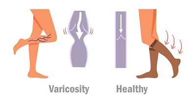 varicose veins