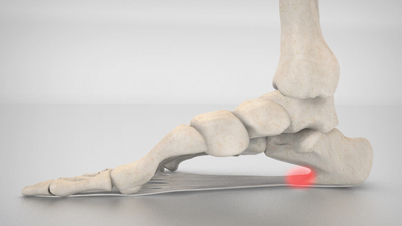Image of foot bones and area affected by heel spurs Image of foot bones and area affected by heel spurs