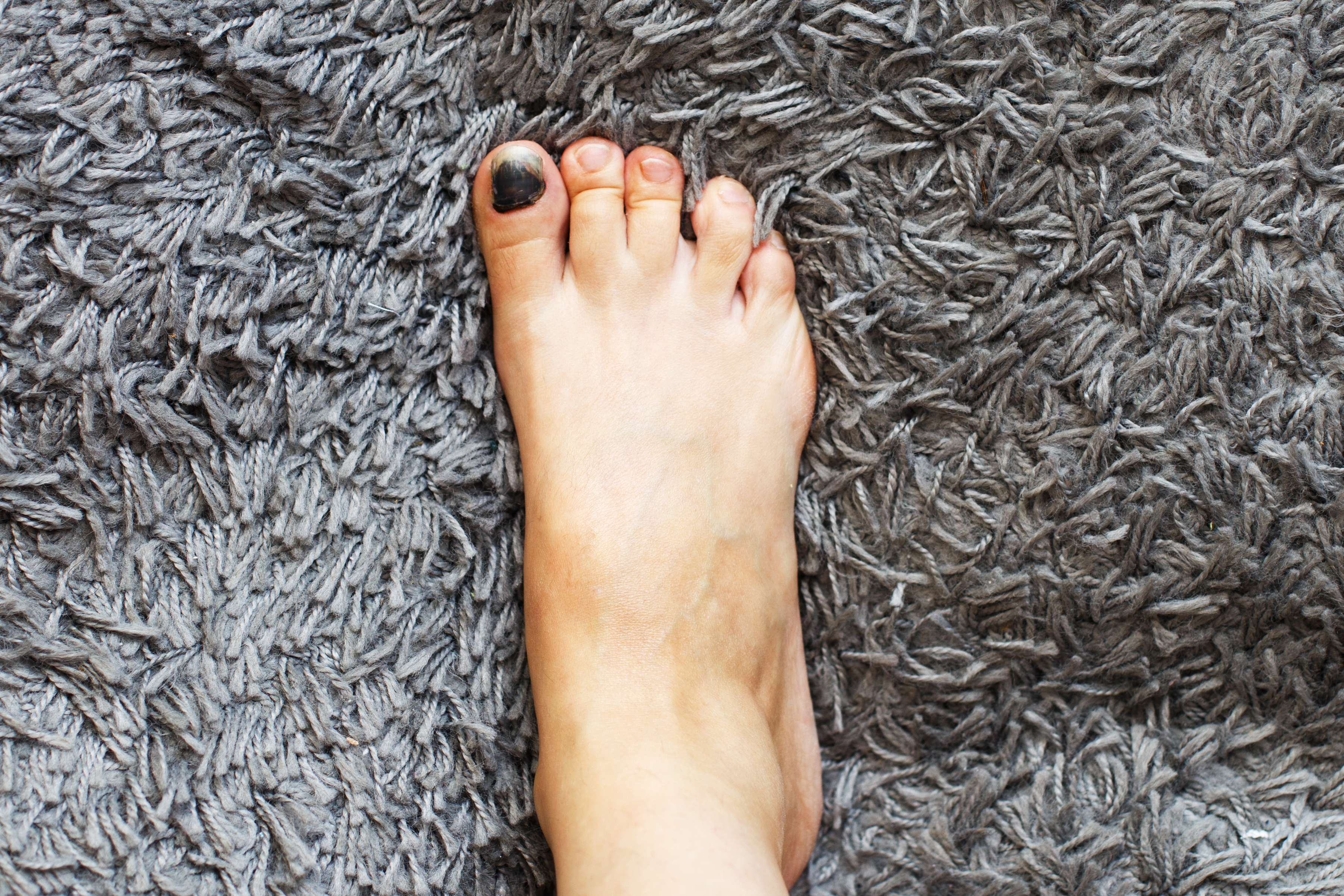 Bruise on toenail on gray carpet Bruise on toenail on gray carpet