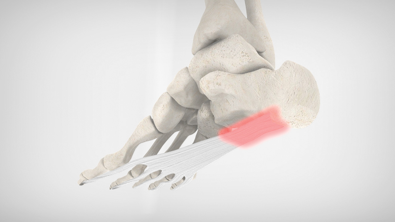 Image of foot bones and area affected by plantar fasciitis Image of foot bones and area affected by plantar fasciitis